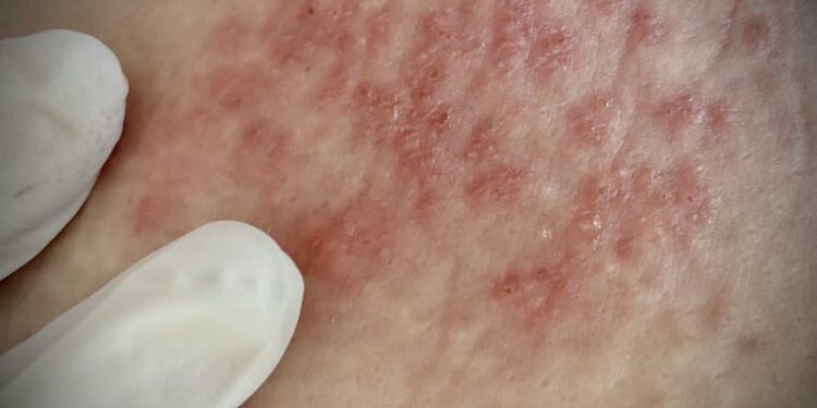 Shingles vaccination rates rose during the COVID-19 pandemic, but major gaps remain for underserved groups