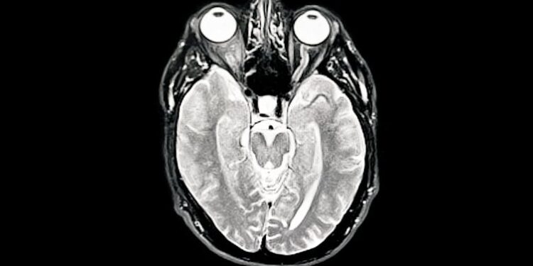 Vaccines hold tantalizing promise in the fight against dementia