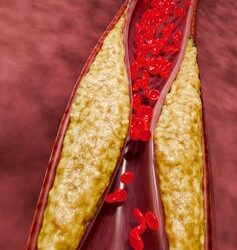 More Americans meet criteria for high blood pressure under new guidelines