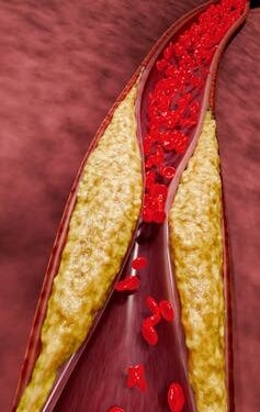 More Americans meet criteria for high blood pressure under new guidelines