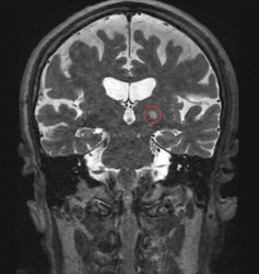 Focused sound energy holds promise for treating cancer, Alzheimer’s and other diseases