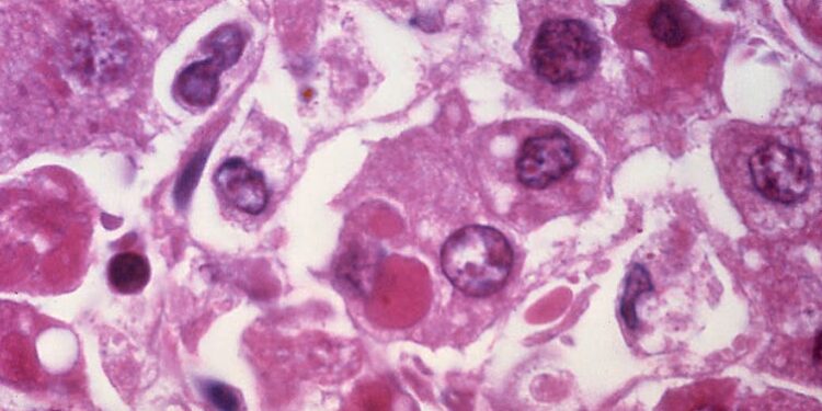 US exit from the World Health Organization marks a new era in global health policy – here’s what the US, and world, will lose