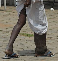 Billions of dollars, decades of progress spent eliminating devastating diseases may be lost with undoing of USAID