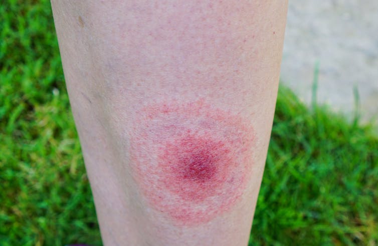 A red, bullseye-shaped rash on the back of a human leg.