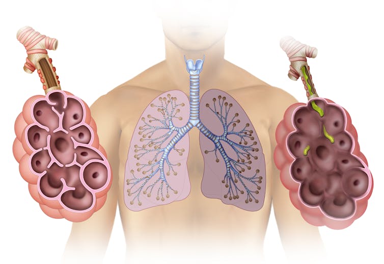 Illustration of a human torso showing the lung divided into two sections, one healthy (on left) and the other affected by pulmonary emphysema on the right.