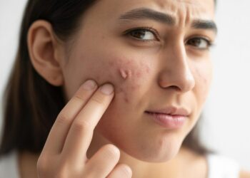 Why Is Your Skin Still Breaking Out? Root Causes and Effective Solutions