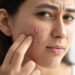 Why Is Your Skin Still Breaking Out? Root Causes and Effective Solutions