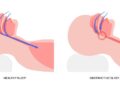 Sleep apnea compromises far more than a good night’s rest – 2 neuroscientists outline the risks and the need for better diagnosis