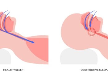 Sleep apnea compromises far more than a good night’s rest – 2 neuroscientists outline the risks and the need for better diagnosis