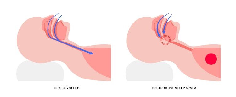 Sleep apnea compromises far more than a good night’s rest – 2 neuroscientists outline the risks and the need for better diagnosis