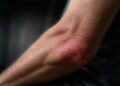 The Truth About Inflammation and Chronic Disease: Facts, Risks, and Effective Strategies