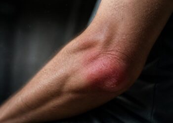 The Truth About Inflammation and Chronic Disease: Facts, Risks, and Effective Strategies