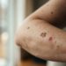 What to Ask Your Doctor If You Notice New or Changing Skin Spots