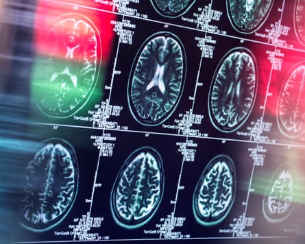 The doctor who mends broken brains: why there is room for hope after a stroke or head injury