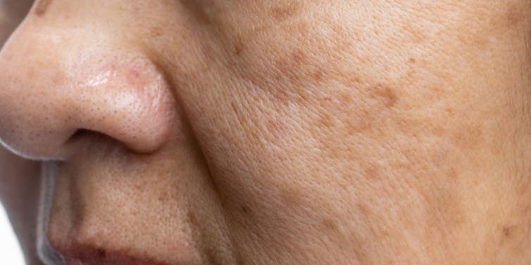 Close-up photo of facial skin showing brown marks and signs of photoaging
