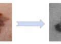 AI skin cancer detection tools are getting better – but only for people with light skin