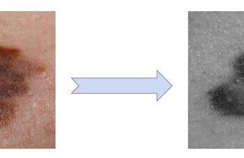 AI skin cancer detection tools are getting better – but only for people with light skin
