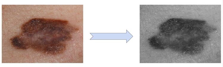 AI skin cancer detection tools are getting better – but only for people with light skin