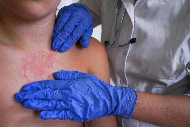 Gloved hands of a medical professional examine a rash on a child's chest.