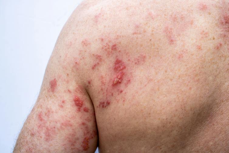 Close-up of red rash across a person's upper back and arm