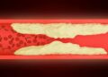 Leg pain can warn of a serious condition: Why peripheral artery disease (PAD) needs more attention