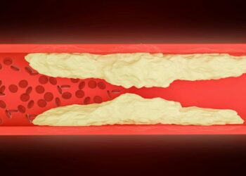 Leg pain can warn of a serious condition: Why peripheral artery disease (PAD) needs more attention