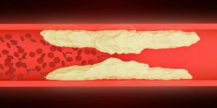 Leg pain can warn of a serious condition: Why peripheral artery disease (PAD) needs more attention