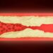 Leg pain can warn of a serious condition: Why peripheral artery disease (PAD) needs more attention