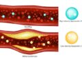 Cholesterol control gets personalized – a cardiologist explains how new guidelines tailor treatment to your unique risk profile