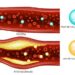 Cholesterol control gets personalized – a cardiologist explains how new guidelines tailor treatment to your unique risk profile