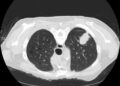 Pope Leo XIV’s lung cancer highlights growing number of nonsmokers diagnosed with the disease – and younger people too