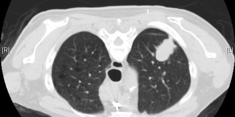Pope Leo XIV’s lung cancer highlights growing number of nonsmokers diagnosed with the disease – and younger people too