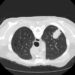 Pope Leo XIV’s lung cancer highlights growing number of nonsmokers diagnosed with the disease – and younger people too